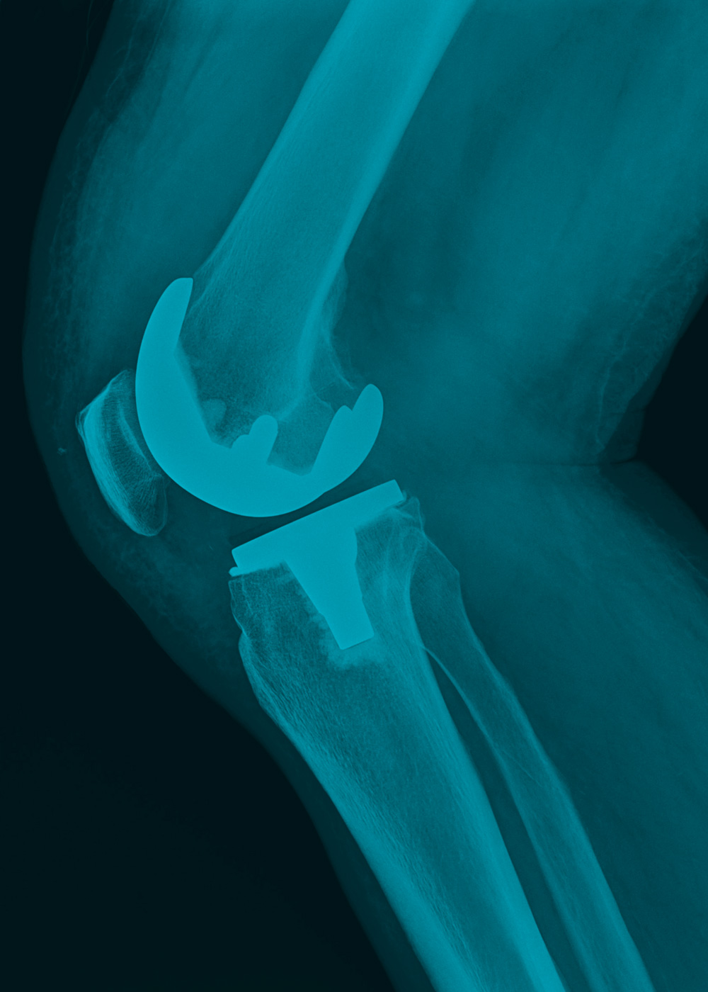 Prótesis de rodilla y <br>componentes femorales blue image