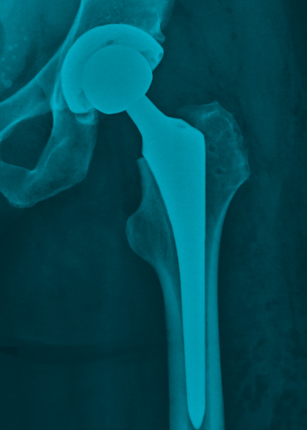 Hip femoral stems blue image
