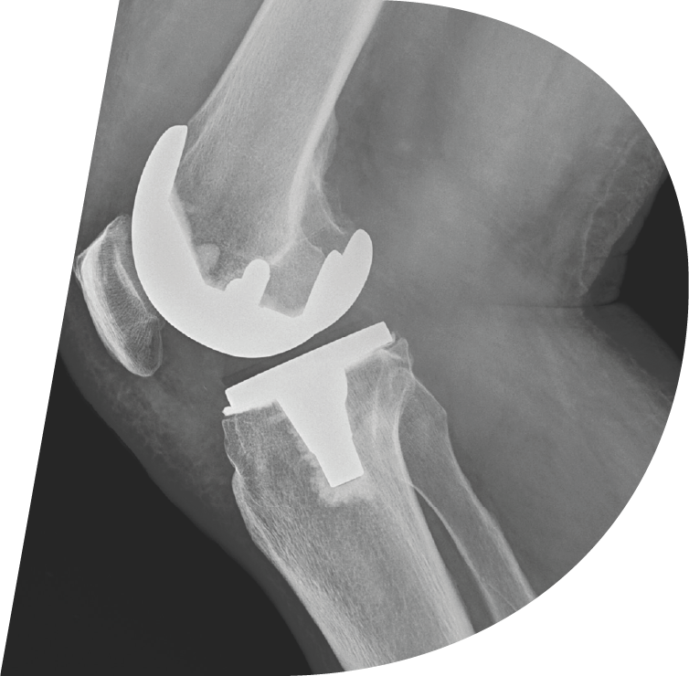 Prótesis de rodilla y <br>componentes femorales